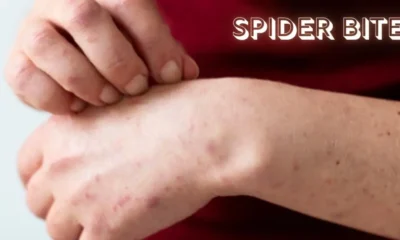 Spider Bite