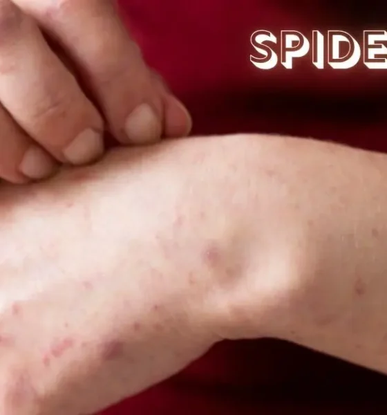 Spider Bite