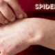 Spider Bite