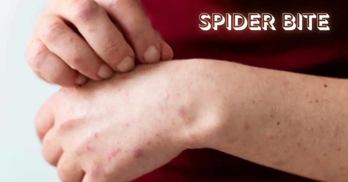 Spider Bite